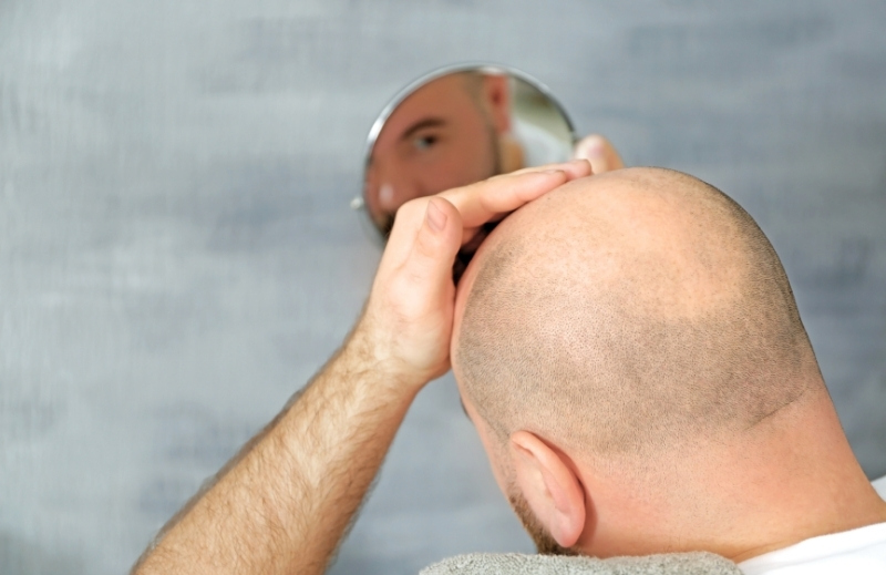 Hair Transplantation 1